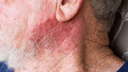 Novo imunoterápico é aprovado pelo FDA para o tratamento do câncer de pele