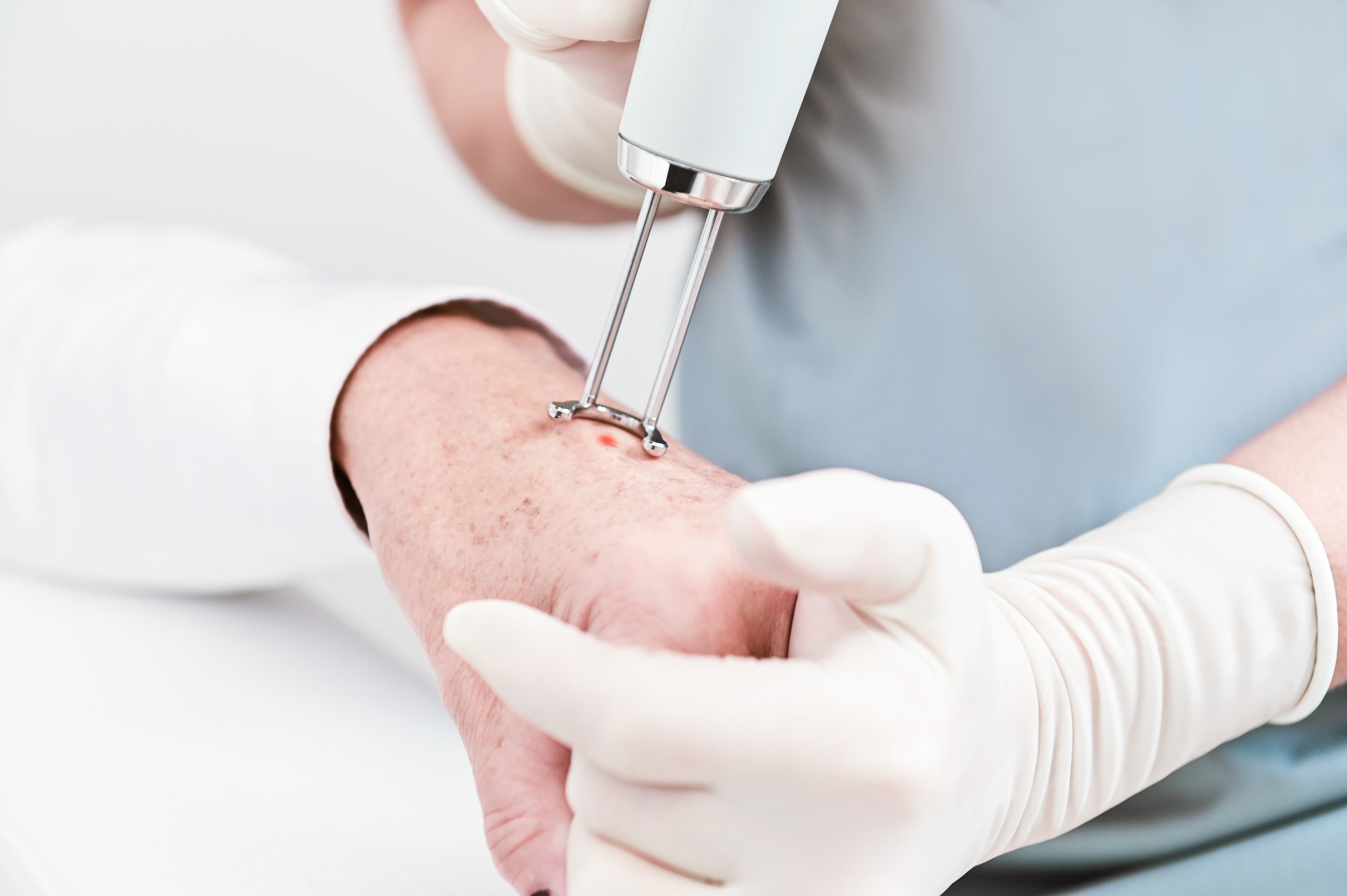 Cemiplimabe recebe aprovação da ANVISA para o tratamento adjuvante do câncer de pele