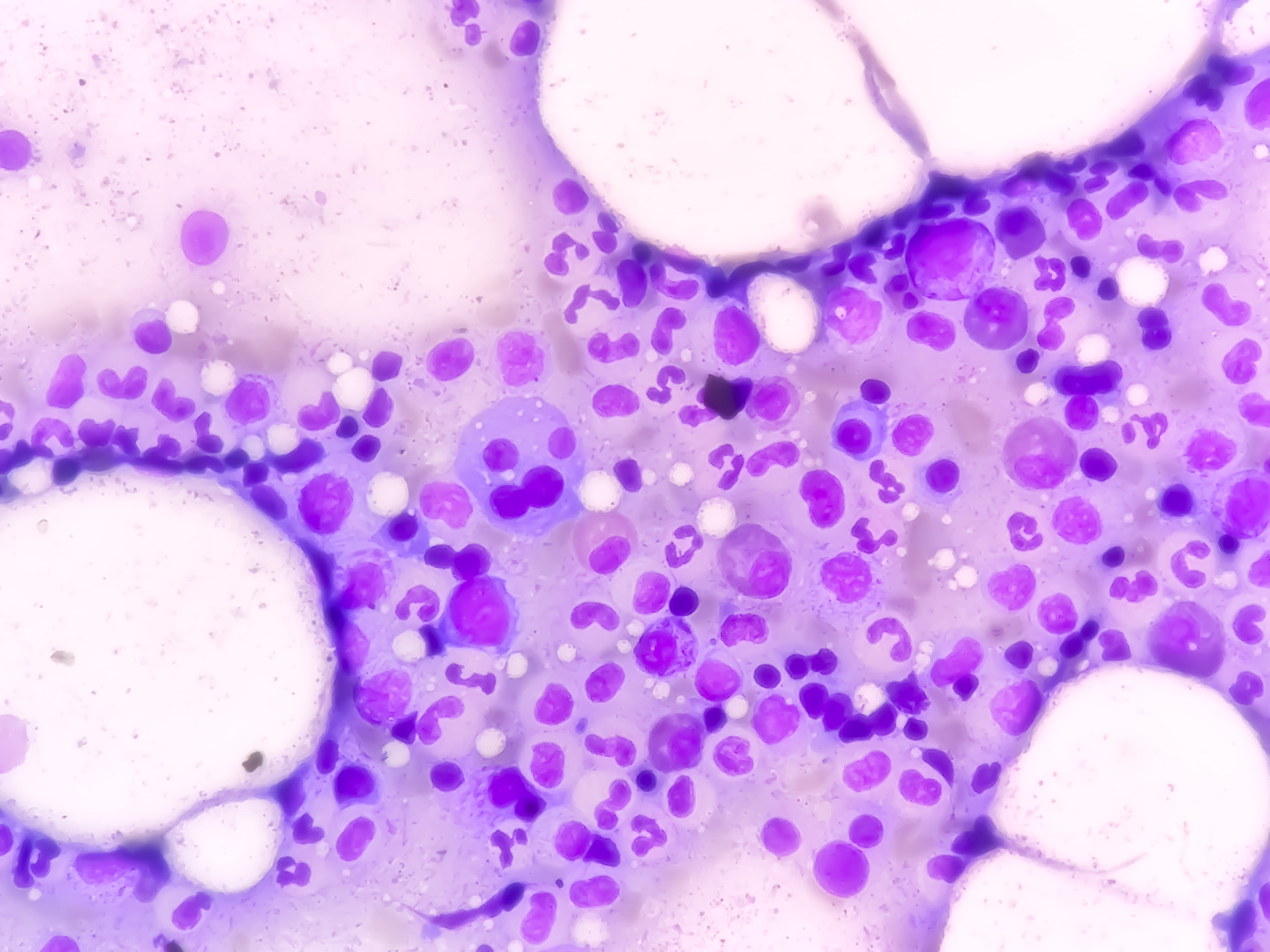 Daratumumabe recebe aprovação de nova indicação terapêutica em formulação subcutânea pelo FDA