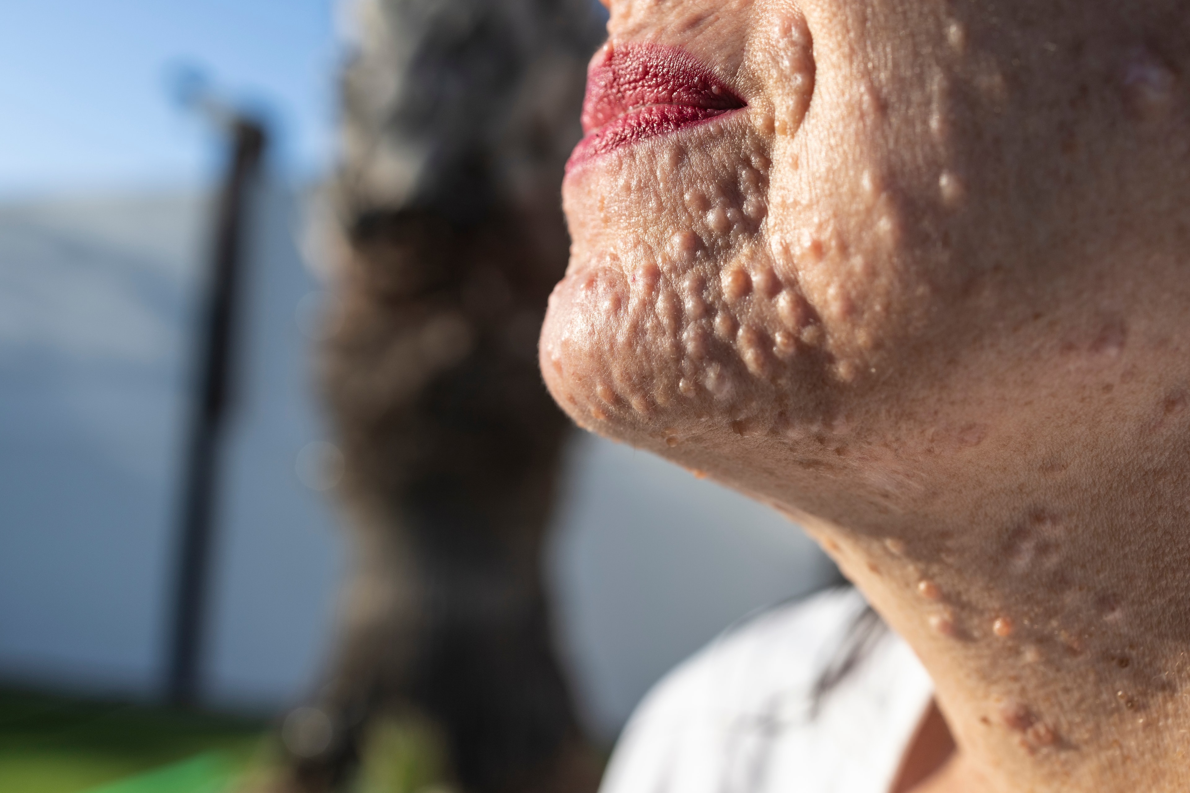 Selumetinibe tem aprovação expandida pelo FDA