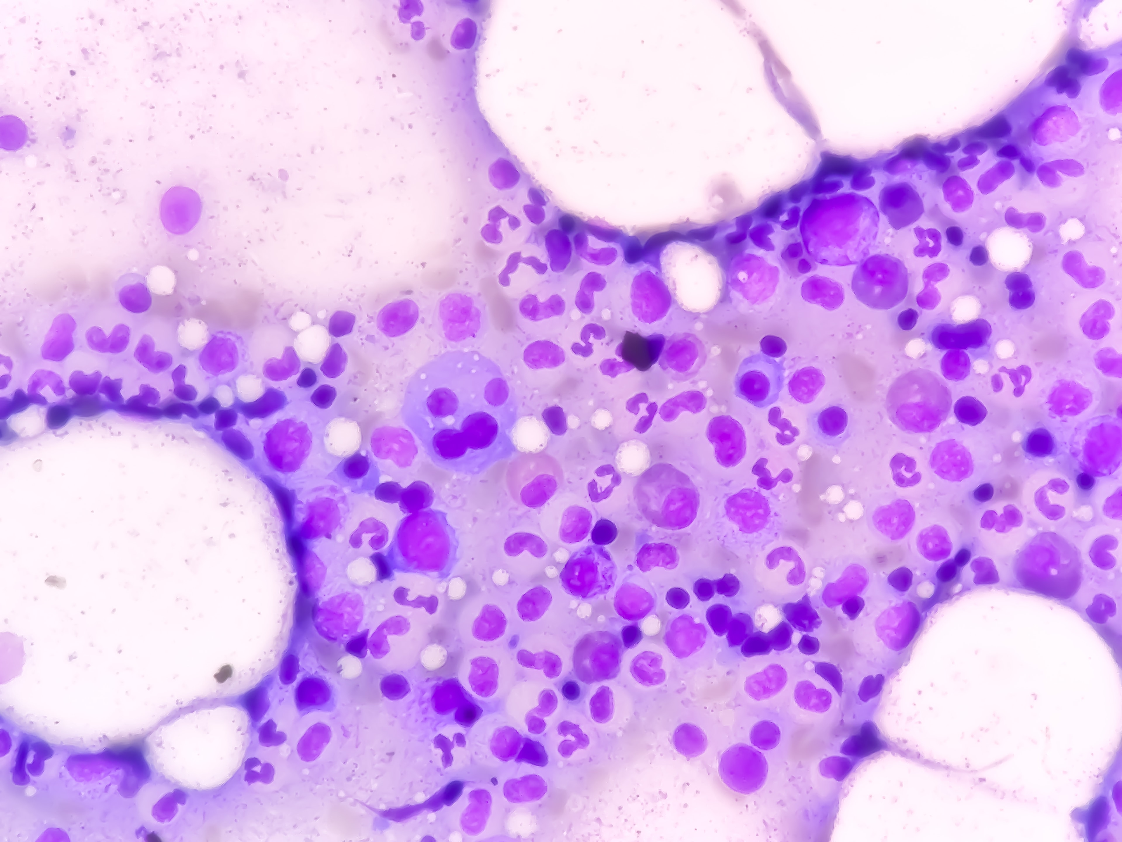 Daratumumabe recebe aprovação de nova indicação terapêutica em formulação subcutânea pelo FDA